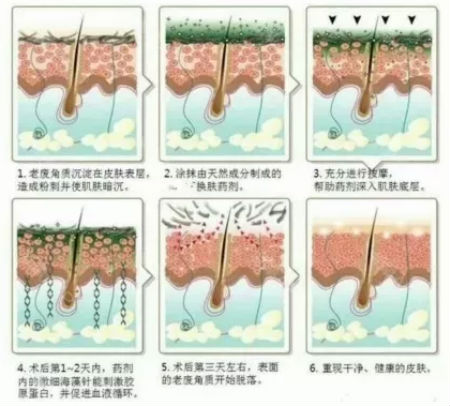 NEWNEW|修復痘坑痘印還得靠海藻煥膚