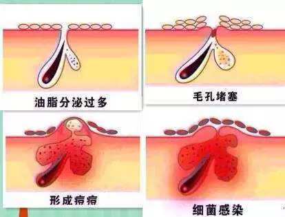 New&New|比春敏更痛苦的事...不要讓爆痘毀了你的臉！