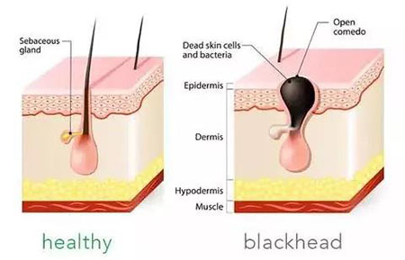黑頭總是去不掉？這可能是 全 有效的去黑頭指南了！